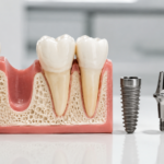 dental implant step by step