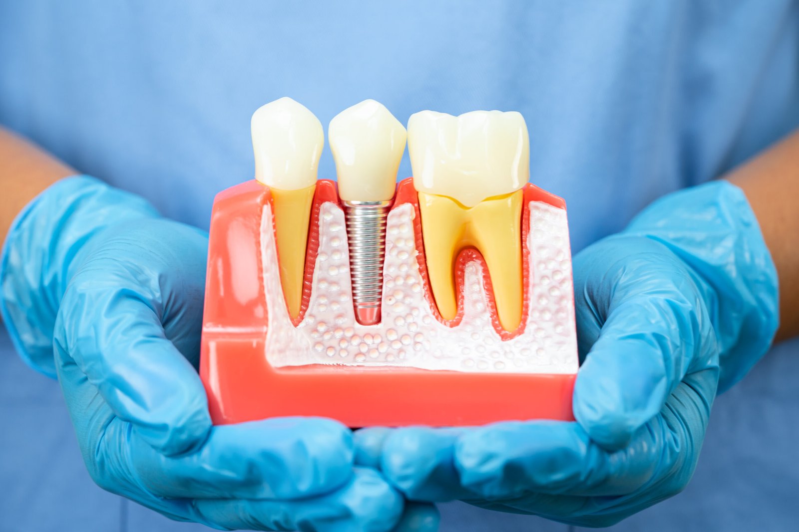 Implan Gigi Berbaloi Ke? Perbandingan Lengkap dengan Jambatan Gigi 2 dental implant
