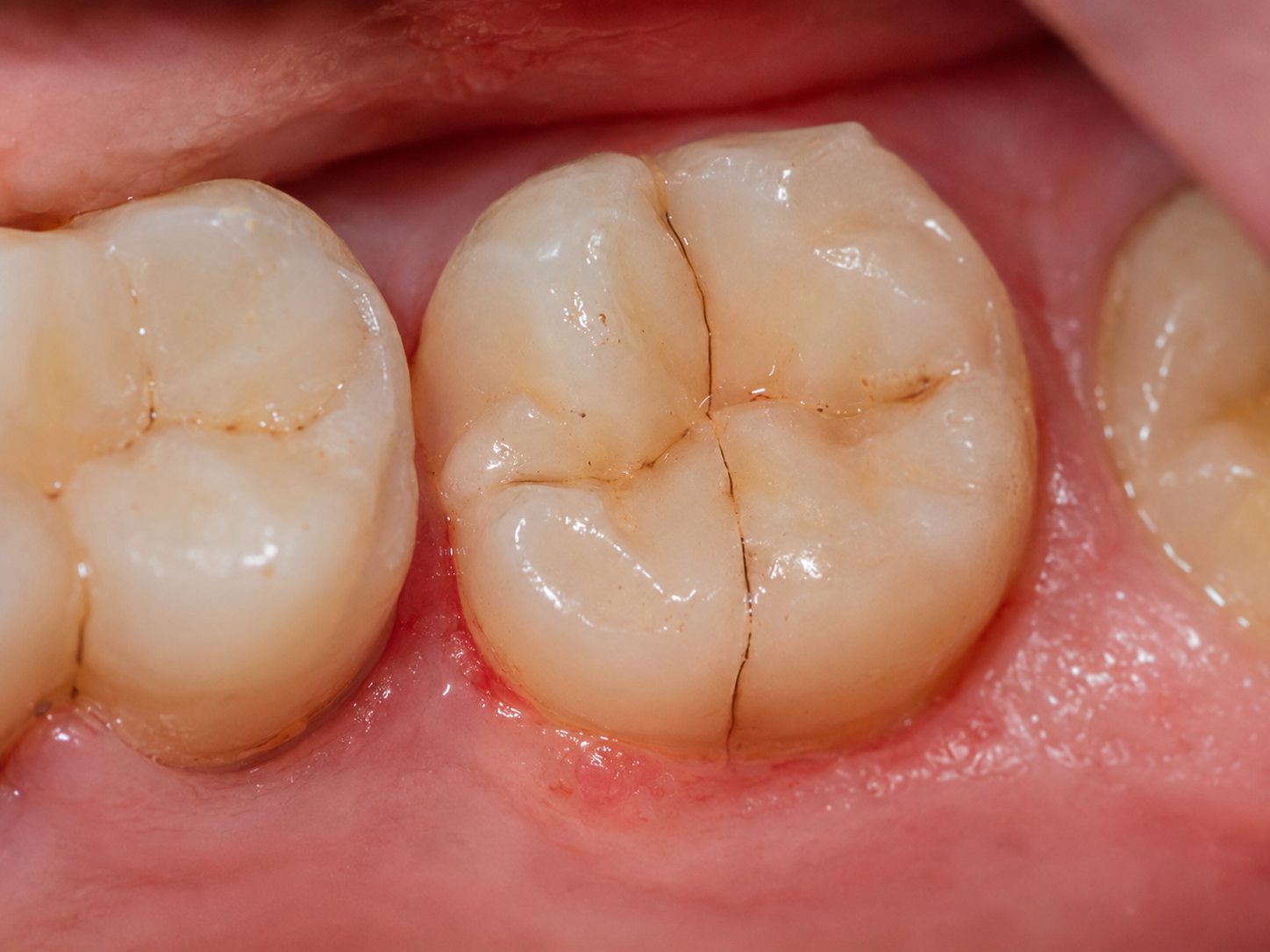 cracked or chipped tooth