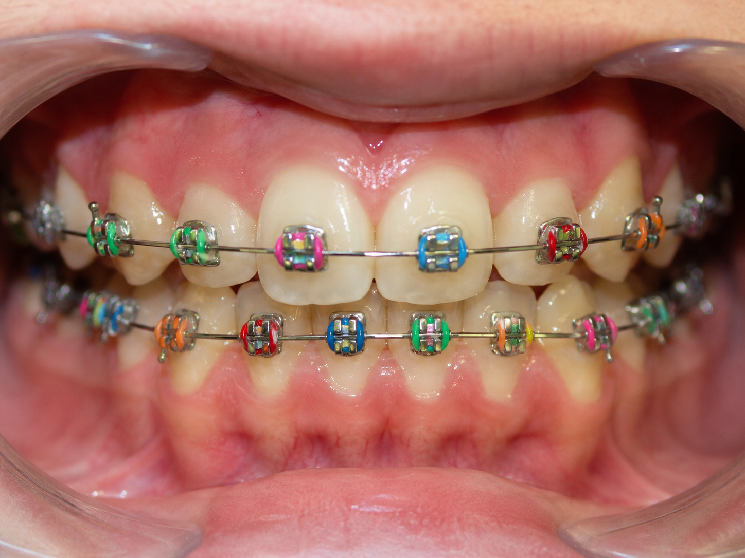 Braces Konvensional
