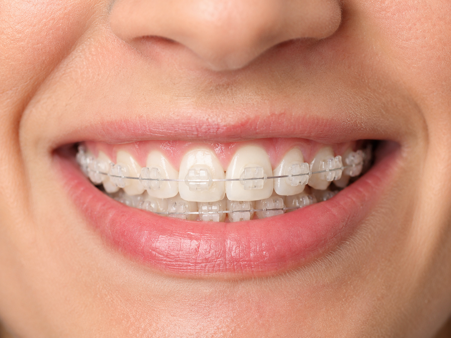 Braces Seramik
