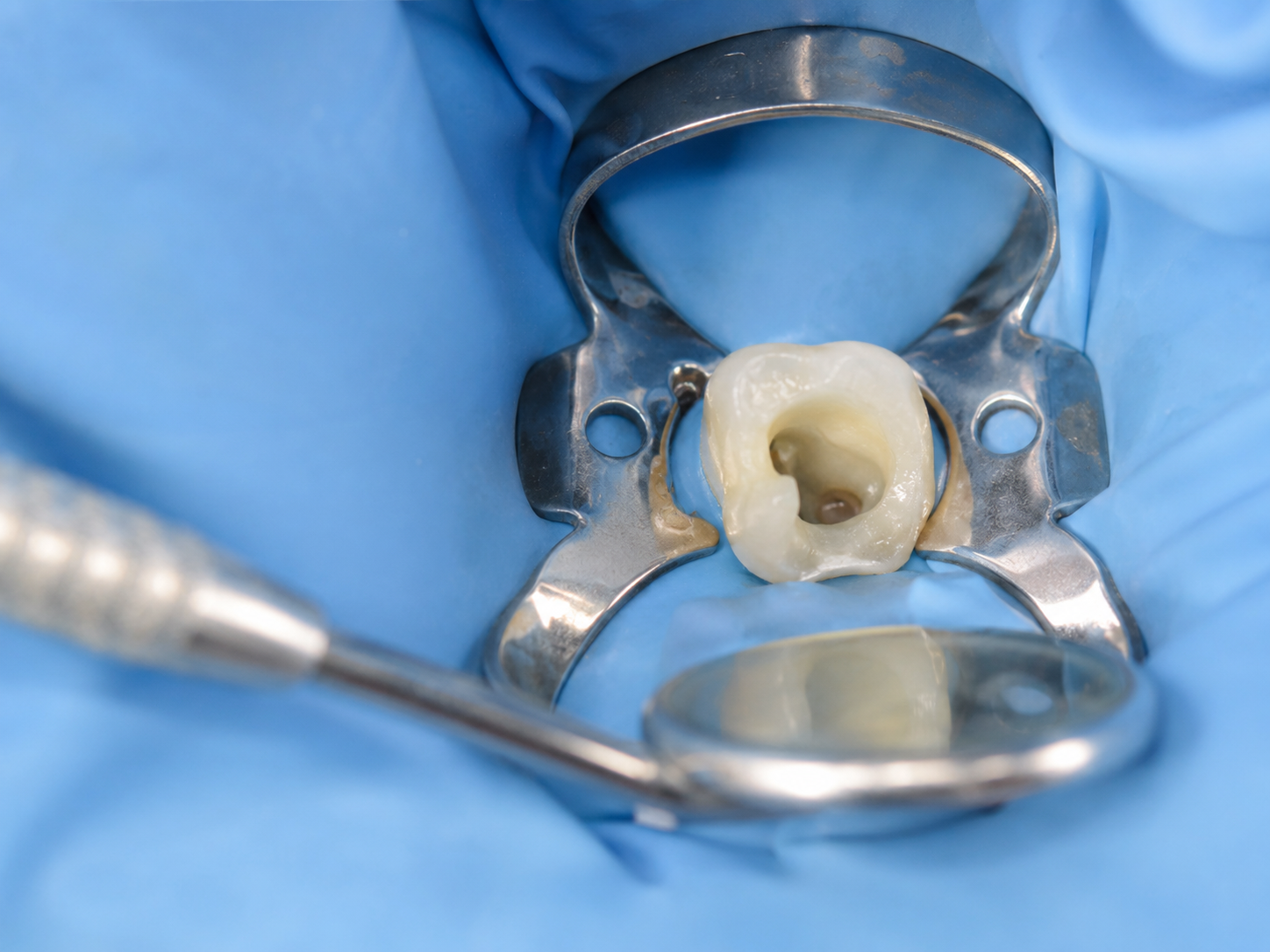 Root Canal Procedure in Malaysia: What Happens at Every Step 4 Rubber dam used during root canal treatment